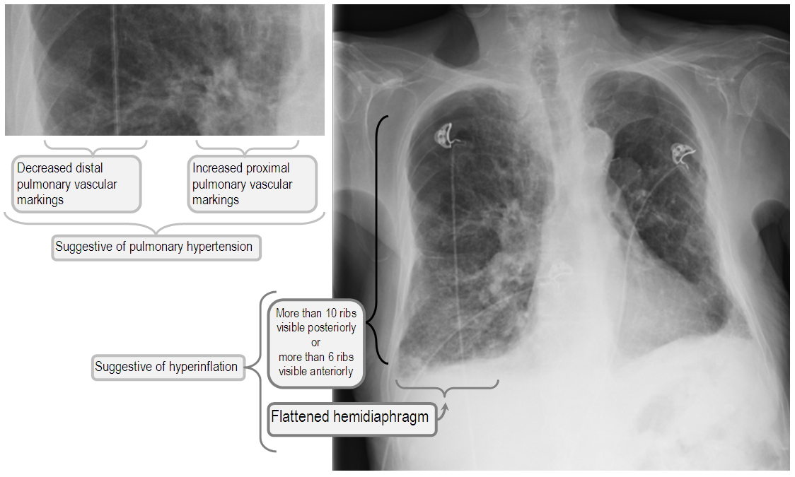 Ventilation strategies for COPD Deranged Physiology